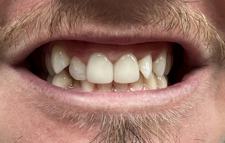 Crown & Bridge After