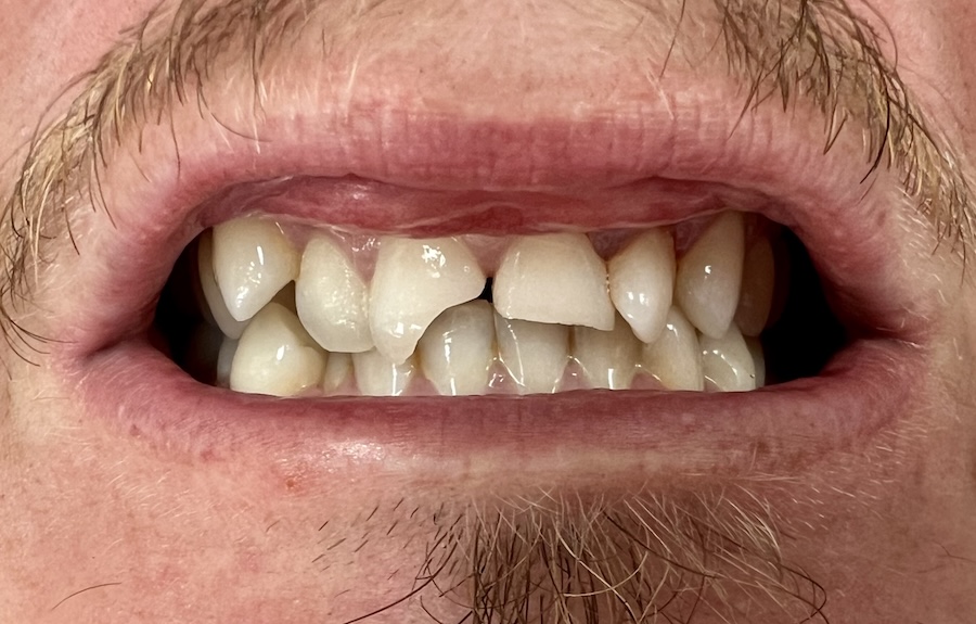 Crown & Bridge Before