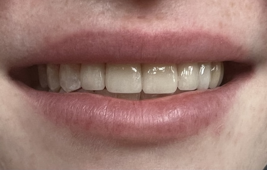 Crown & Bridge After