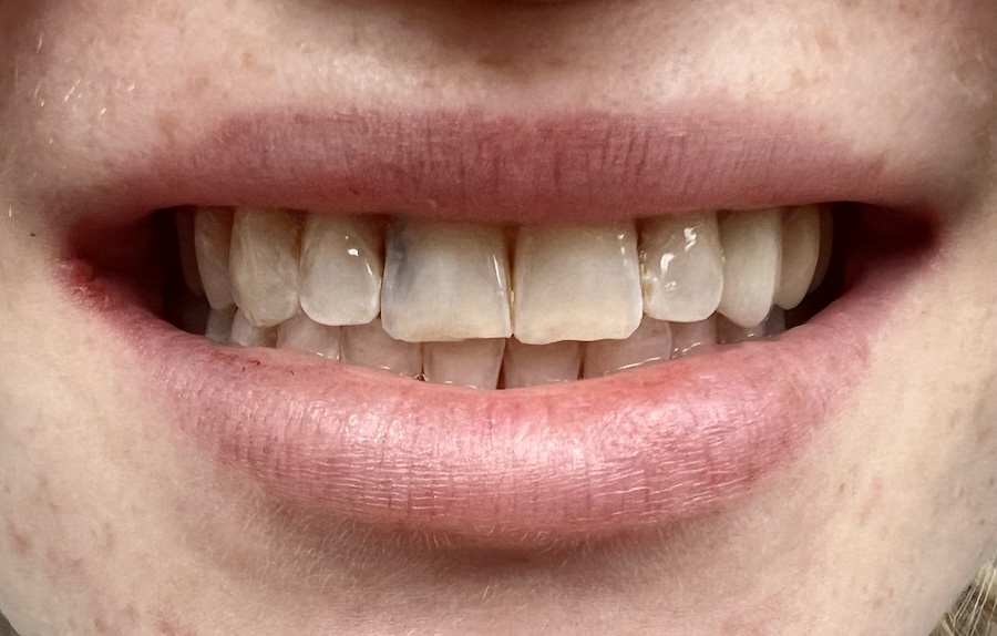 Crown & Bridge Before