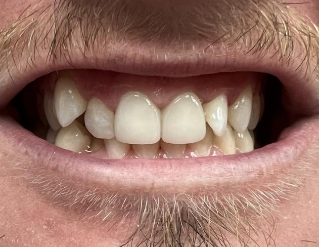 Crown & Bridge After