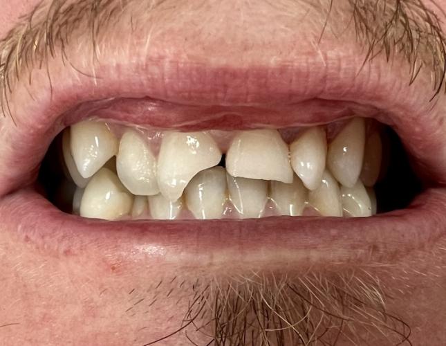 Crown & Bridge Before