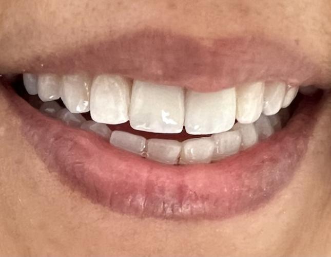 Crown & Bridge 3 After