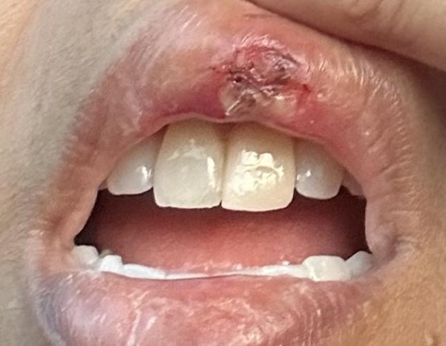 Crown & Bridge 3 Before