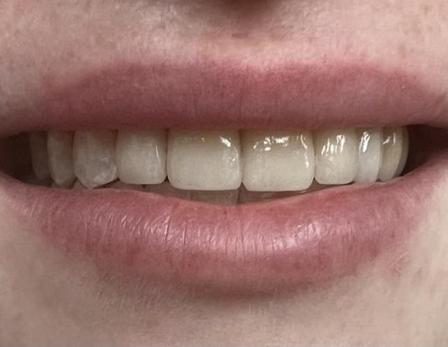 Crown & Bridge After