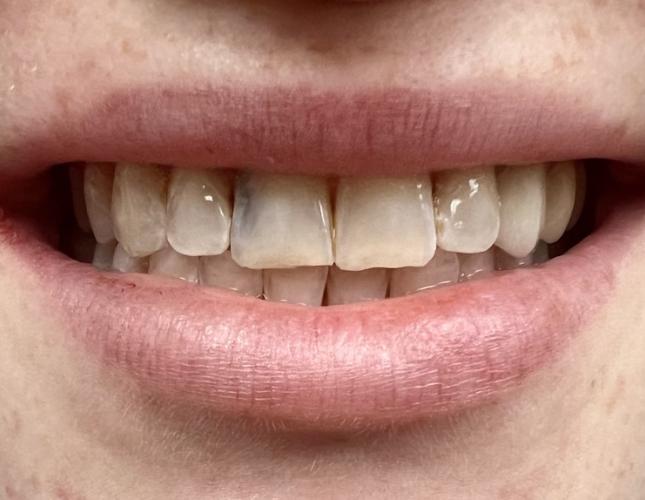 Crown & Bridge Before