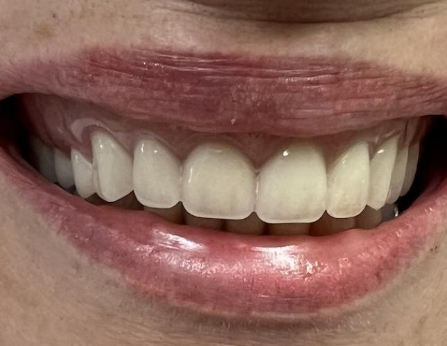 Full Mouth Restoration After
