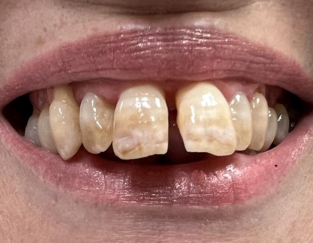 Full Mouth Restoration Before