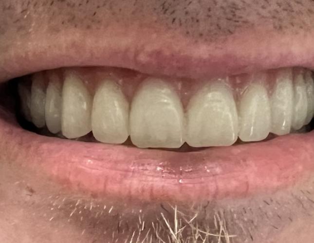 Full Mouth Restoration After