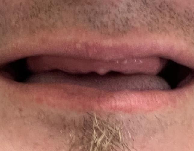 Full Mouth Restoration Before